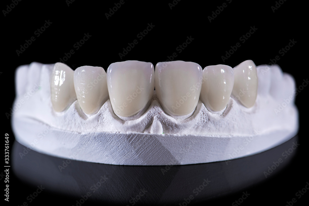 Metal free ceramics crown